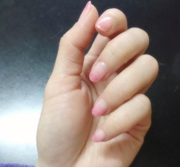 怎么摆脱灰指甲